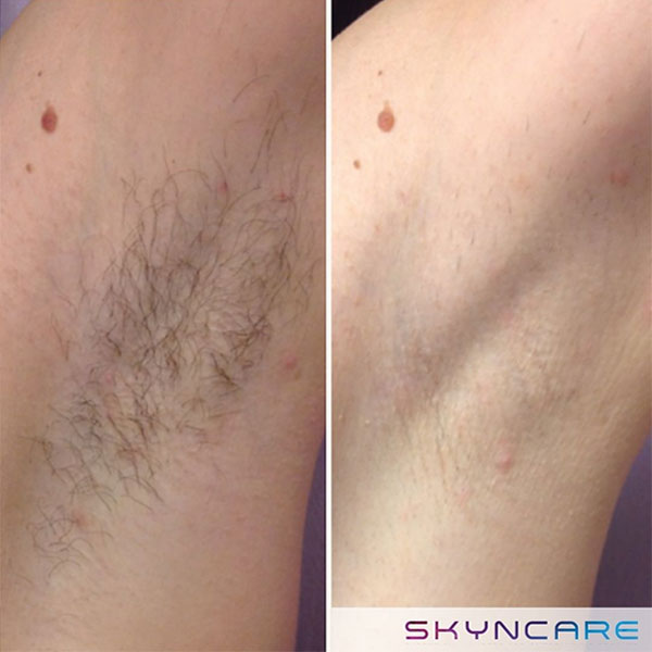 Before and after of underarm hair removal in Ruthin