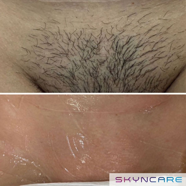 Before and after of bikini line hair removal in Ruthin