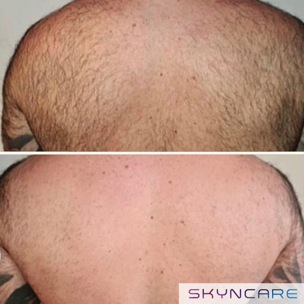 Before and after of back hair removal in Ruthin