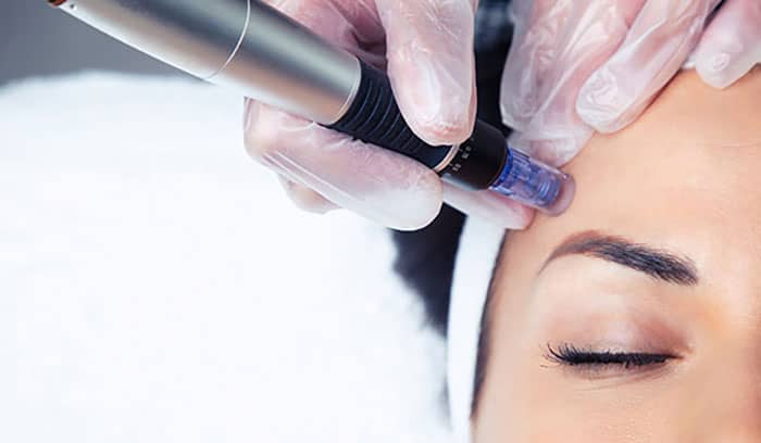 Woman receiving microneedling in Ruthin